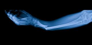 Image result for Fracture XRay
