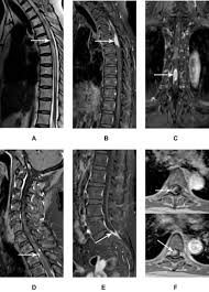 Tuberculosis (tb) is 100% curable if treated with the approved four drug combination for a minimum of six months. Differentiation Of Intraspinal Tuberculosis And Metastatic Cancer Usin Idr