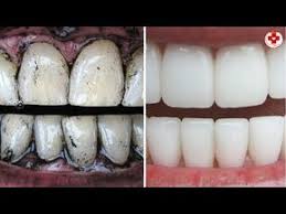 Sbiancamento Denti In 1 Uso Come Sbiancare I Denti A Casa Con Il Carbone Vegetale Attivo Yo Sbiancamento Naturale Dei Denti Denti Bianchi Sbiancare I Denti