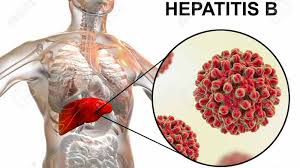 Cara Mengobati Hepatitis B Dengan Olahan Temulawak Lampung Co