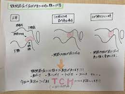 顎関節症の原因「TCH」とは？｜名古屋市東区の歯医者「てらもと歯科医院」