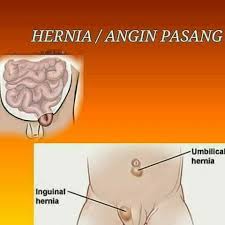 Bagi angin pasang jenis inguinal, ia terjadi apabila pundi kencing atau usus terkeluar sehingga ke kantung testis. Krim Merawat Tiroid Benjolan Angin Pasang Buasir Dan Astma Apa Dia Hernia Angin Pasang Bayi Atau Kanak Kanak Lelaki Lebih Cenderung Menghidap Penyakit Angin Pasang Berbanding Bayi Dan Kanak Kanak Perempuan
