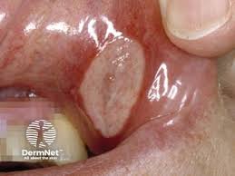 Image result for Mouth ulcers roof of mouth