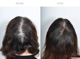 Before & after results | hairmd, pune. Prp Hair Treatment Before After Photo Gallery Haircaremd Nyc
