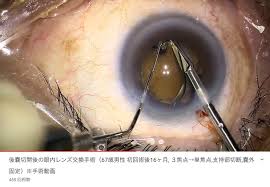 白内障やり直し手術 眼内レンズ交換について⑧；うまくいかなかったケース | たまプラーザやまぐち眼科 『眼の質問・疑問・お悩み相談』ブログ