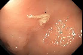 Image result for Pinworm