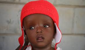 Success! Victoria from Kenya raised $685 for congenital hydrocephalus.