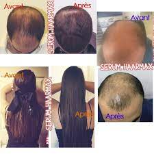 Normally $37.95, but for a limited time get the hairguard 1mm titanium dermaroller free, just cover the. Hair Growth Serum And Its Derma Roller Haarmax