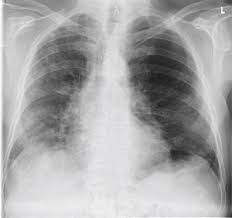 Unless specifically labeled as probable cases. Ct Diagnostik Verbessert Prognose Fur Verlauf Einer Covid Pneumonie