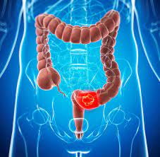 Zahlreiche techniker und wissenschaftler, die mit der neuen methode zur durchleuchtung von körpern arbeiteten, erkrankten an krebs. Darmkrebs Erkrankungen Bei Jungen Menschen Steigen An Welt