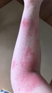 Scabies skin human poison ivy leaves poisoned skin poison ivy skin poison ivy allergy itching skin poison rash rash icons poison ivy poison oak rash. Helped Granny In Her Yard And Discovered I M Very Allergic To Poison Ivy Wellthatsucks