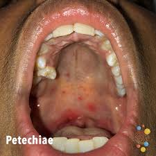 Increasing petechiae, ecchymosis, or bleeding •petechial rash can progress to purpura fulminans •can lead to limb ischemia •adrenal insufficiency •shock Petechiae Skin Deep