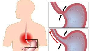 We did not find results for: Arsura Retrosternala Pirozis Vs Infarct De Miocard Reginamaria Ro