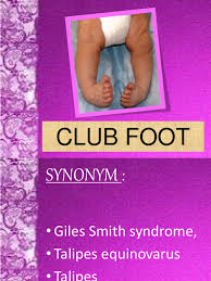 Most clubfeet can be successfully corrected using the nonsurgical ponseti method. Club Foot Foot Hip