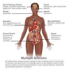 Symptoms of multiple sclerosis (ms) may be similar to those of many other nervous system disorders. What To Know About Multiple Sclerosis Abc News