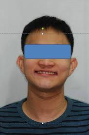 Astra implant의 성공율 및 골소실율