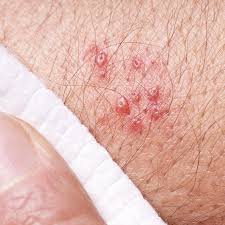 Image result for shingles