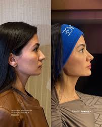 Lifting Facial sin cirugía con técnica BHB+ ✓ ¿Cuántos ml crees que  utilizamos? 💉 Duración: 12-18 Meses ⏱️ Dolor: 3/10 escala de EVA 🔥  Resultados inmediatos 🕰️ No se requiere reposo ❌