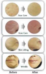 Derma Rollers Your Daily Skin Care Regimen Derma Roller Daily Skin Care Regimen Skin Needling