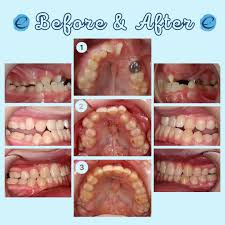First 5 Days Of Having Braces In 2022 | Newpark Orthodontics
