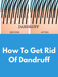 How To Get Rid Of Dandruff Today I Am Going To Share Some Wonderful Homemade Recipes Made From Natural Getting Rid Of Dandruff Dandruff How To Remove Dandruff