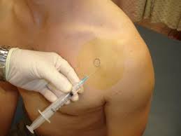 Image result for Subacromial Space Injection