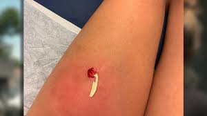 A Woman Infected With Flesh Eating Bacteria After Just 10 Minutes In Water Wbtw