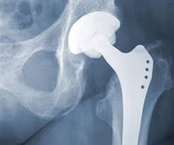 It may also be more challenging to get around the house initially, so you might need more support at home. Hip Replacement Procedure Symptoms Types Of Implants And Risks