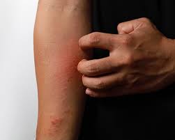 Image result for skin rash acute hiv infection