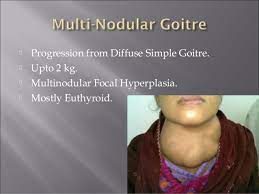 Differences in aetiology and thyroid function in endemic goitre between rural and urban areas of the darfur region of the sudan. Diffuse Toxic Endemic Goiter