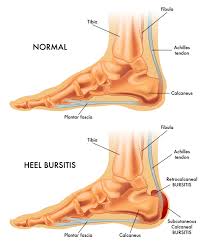 Image result for Bursitis