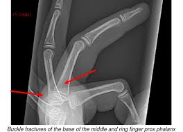 Avulsion fractures take place whilst the ligaments between the bones are under pressure and rip off the little bit of bone they're linked to. Hand And Finger Fractures
