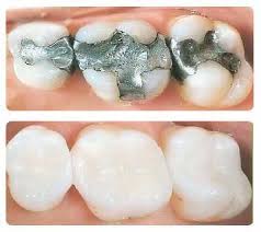 Make sure you dont pack a tooth that is abscessed, that will required. Choosing The Right Type Of Dental Filling