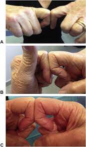 Since the ring finger protrudes the farthest in the grasping position, it is more susceptible to fdp avulsion causing an inability to flex at the dipj. A Simple Diagnostic Sign For Rupture Of The Flexor Digitorum Profundus Journal Of Hand Surgery