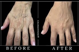Typically treatments last between 15 to 20 minutes. Omni Aesthetics Home Facebook