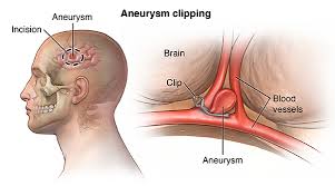 Many unruptured brain aneurysms are found due to neurological symptoms caused by the size of the aneurysm. Cerebral Aneurysm Cedars Sinai
