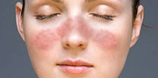 Durante años le diagnosticaron una alergia y resultó ser una extraña  enfermedad