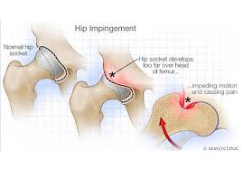 Image result for Hip Labral Tear