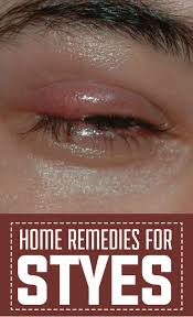 Home Remedies For Styes Eye Stye Remedies Remedies Home Remedies