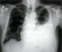 Pleural effusion (transudate or exudate) is an accumulation of fluid in the chest or on the lung. Pleural Effusion Amboss