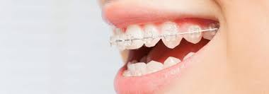 Insurance that covers braces for adults. How To Straighten Uncentered Teeth When You Can T Afford Braces