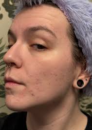 What face oil recommendations are there for PIE?