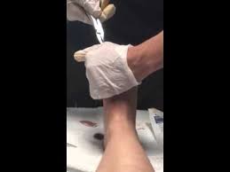 K Wire Removal Bunion Surgery How To Remove Wire