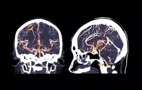 A menudo, la rotura de un aneurisma cerebral se produce. Ressonancia Magnetica Com Contraste Como E Feita Doencas E Riscos