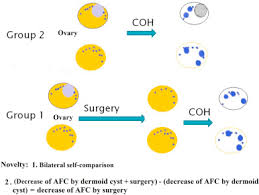 They said they couldn't even see my ovaries on the ultrasound. Effect Of Ovarian Dermoid Cyst Excision On Ovarian Reserve And Response Insights From In Vitro Fertilization Sciencedirect
