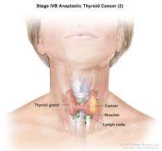 Endocrine Surgery Thyroid Cancer