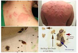 Amazing Bed Bugs Pictures Bites Commonly Bite Areas Common