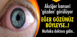 Akciger Kanseri Gozden Goruluyor Akciger Kanseri Meme Kanseri Saglik Ve Fitness