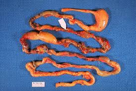 Image result for Necrotizing Enterocolitis