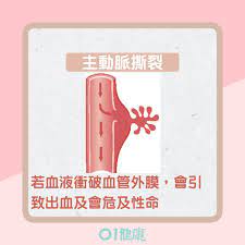 The site owner hides the web page description. å¿ƒè‡Ÿç—… ä¸»å‹•è„ˆæ'•è£‚2æ—¥å…§æ­»äº¡çŽ‡5æˆèƒ¸ç—›è‡³è…°èƒŒ9å¾µç‹€é«˜å±